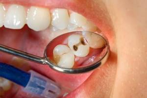 Симптомы фиссурного кариеса и методы лечения заболевания зубов