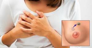Симптомы мастопатии молочных желез и методы лечения патологии