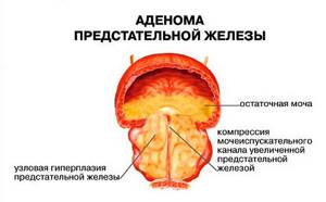 Диагностирование аденомы предстательной железы