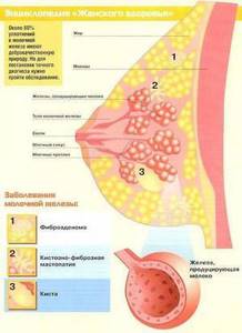 Симптомы и основные методы лечения фиброзно-кистозной мастопатии