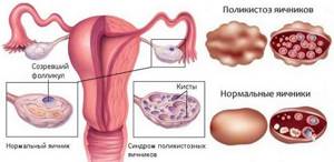 Причины опсоменореи и лечение нарушения менструального цикла