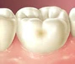 Симптомы начального кариеса и методы лечения заболевания зубов