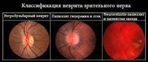 Симптомы неврита зрительного нерва и методы лечения патологии