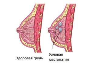 Узловая мастопатия: причины развития и различные формы болезни