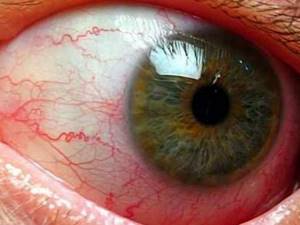 Симптомы увеита и методы лечения патологии глазного яблока