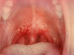 Мокрота в горле без кашля: причины появления и методы лечения