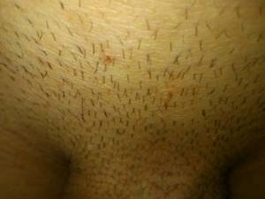 Папиллома в паху у мужчин: симптомы и лечение новообразований