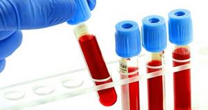 Анализ крови ПСА и общий при простатите: норма и отклонения