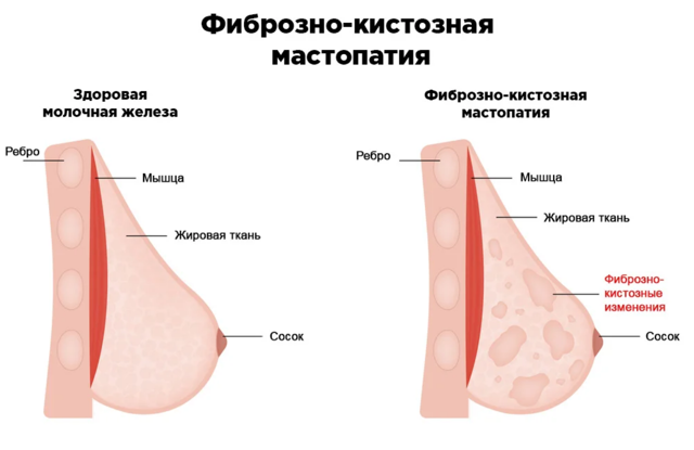 Фиброзно кистозная мастопатия молочных желез: чем опасна болезнь