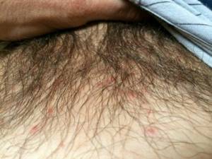 Папиллома в паху у мужчин: симптомы и лечение новообразований