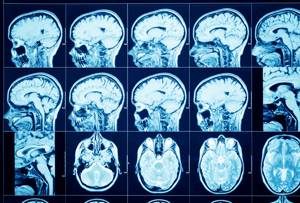 Как исследуют головной мозг методом компьютерной томографии