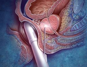 Предстательная железа: размеры мужского органа и допустимая норма