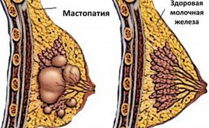 Мастопатия: лечение патологии и применяемые для него препараты