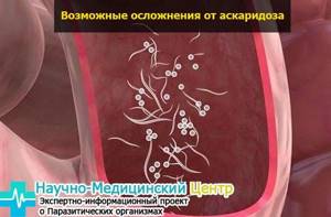 Симптомы аскаридоза и методы лечения глистной инвазии кишечника