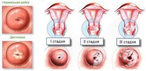 Характерные особенности эрозии шейки матки: симптомы и лечение