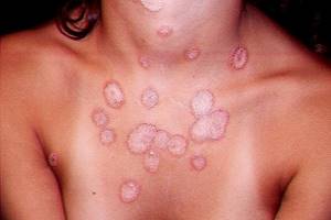 Консультация миколога при грибковых поражениях кожи и слизистых