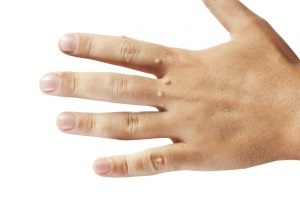 Бородавки на руках: основные причины и эффективные способы лечения