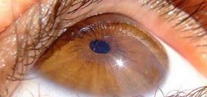 Симптомы отслоения сетчатки глаза и прогноз при заболевании