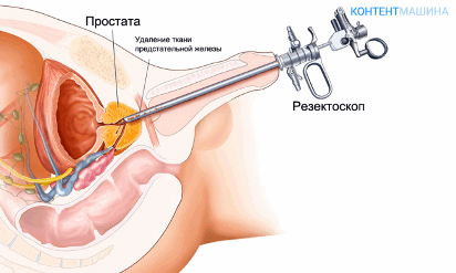 Биопсия предстательной железы: показания и практикуемые методы