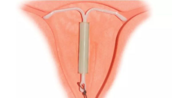 Симптомы фибромы матки и методы лечения доброкачественной опухоли