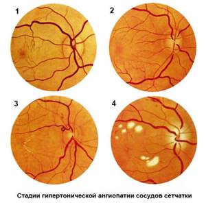 Лечение ангиопатии сетчатки глаз и профилактика осложнений