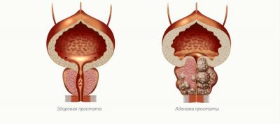 Предстательная железа: размеры мужского органа и допустимая норма