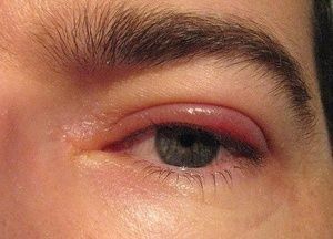 Лечение блефарита и профилактика развития заболевания глаз