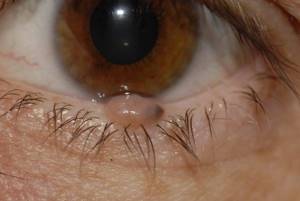 Бородавки на глазах: симптомы и основные способы удаления