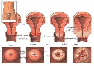 Симптомы рака шейки матки и лечение онкологического заболевания
