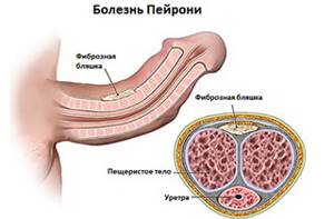 Symptoms of Peyronie&#39;s disease and causes of pathology