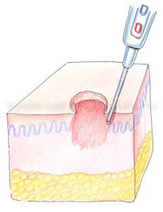 Бородавка под микроскопом: анатомия и структура образования