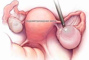 Симптомы и методы лечения эндометриоидной кисты в яичнике
