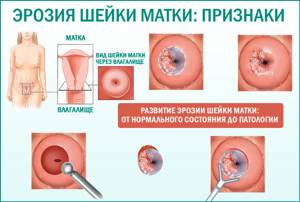 Эрозия шейки матки и ВПЧ: профилактика заражения и лечение