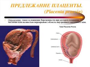 Признаки плацентарного предлежания и прогноз родоразрешения