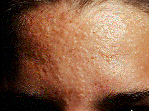 Папилломы на коже: симптомы и методы лечения новообразований