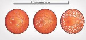 Лечение диабетической ретинопатии и профилактика осложнений