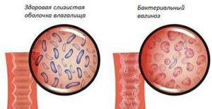 Симптомы дисбактериоза влагалища и методы лечения нарушения