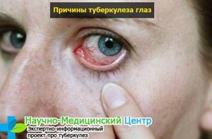 Симптомы развития туберкулеза глаз и способы терапии патологии