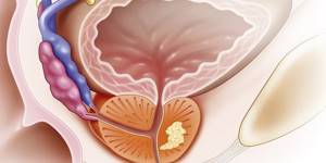 Предстательная железа: лечение и профилактика патологий органа