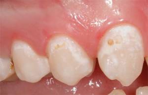 Симптомы начального кариеса и методы лечения заболевания зубов
