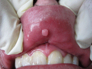 Бородавка во рту: причины появления и методы устранения патологии