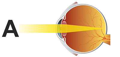 Лечение миопии глаз консервативным и хирургическим методом