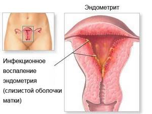 Симптомы метроэндометрита и методы лечения заболевания матки