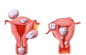 Симптомы фибромы матки и методы лечения доброкачественной опухоли
