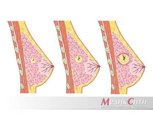 Консультация маммолога при развитии заболеваний молочных желез