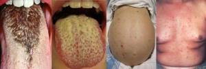 Симптомы брюшного тифа и способы лечения инфекционной патологии