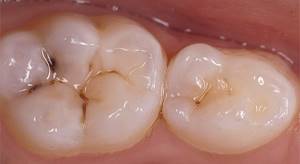 Причины появления и основные симптомы развития кариеса зубов