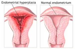 Степени гипоплазии матки и методики диагностики заболевания