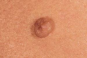 Папилломатоз кожи: клиническая картина и методы лечения патологии