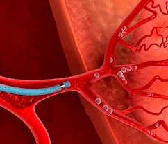 Эмболизация артерий простаты: техника проведения процедуры
